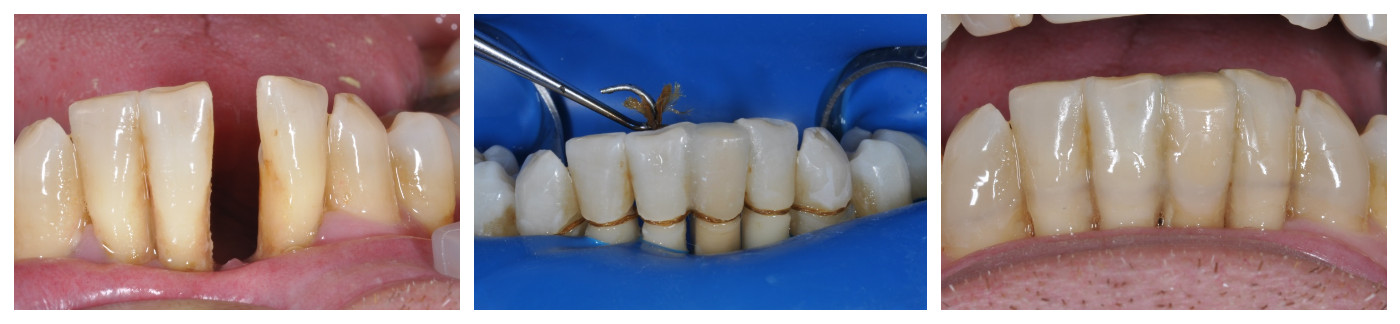 Этапы вантового протезирования зубов