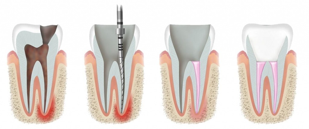 Чистка каналов зуба