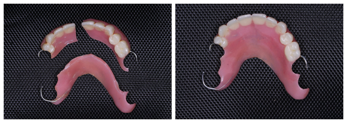 Пример ремонта съемных зубных протезов