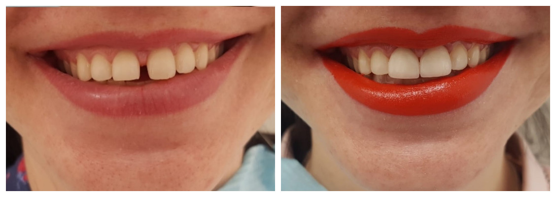 До и после керамической реставрации зубов
