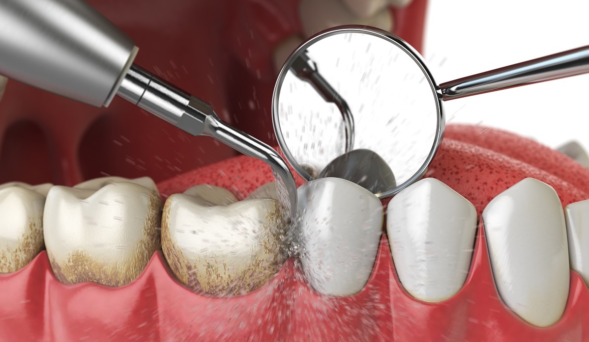 Стоимость ультразвуковой чистки зубов