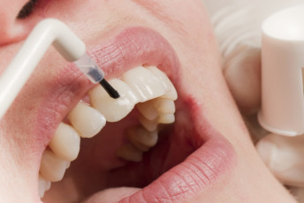Фторирование зубов: нужно ли, эффективность, как делают