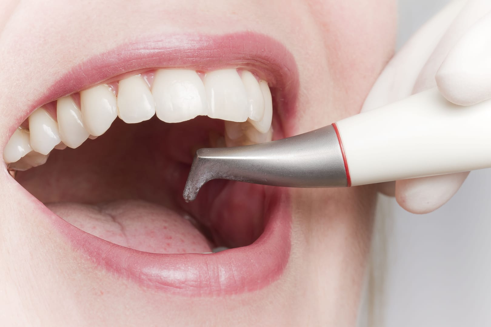Профессиональная чистка зубов Air Flow: когда требуется и как выполняется