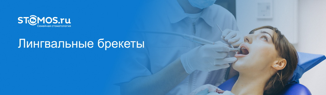 Лингвальные брекеты: виды конструкций, достоинства и недостатки, правила ухода