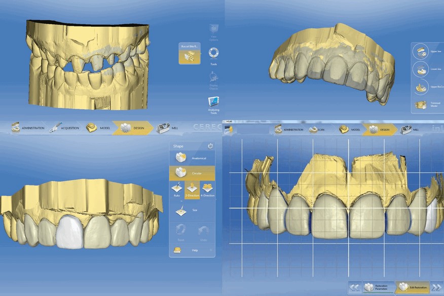Моделирование имплантов, Изготовление зубных имплантов с помощью CEREC