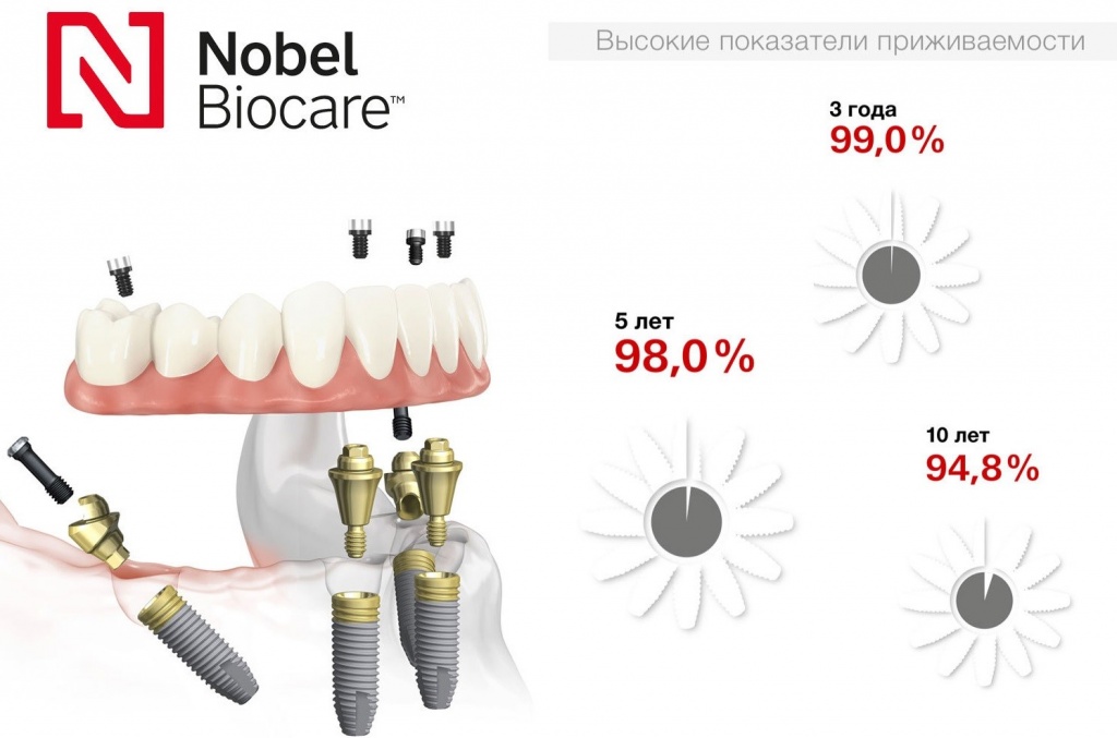 20162374_Preimushhestva implantov Nobel Biocare_6483182.jpg