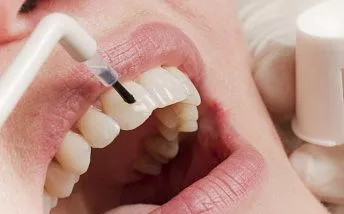 Фторирование зубов: нужно ли, эффективность, как делают