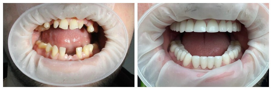 Зубные коронки из диоксида циркония