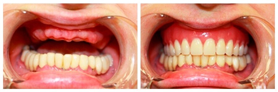 Протезирование зубов при отсутствии зубов цена
